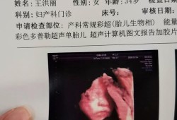 孕妇做四维彩超24周胎儿显示没有胆囊,24周胎儿胆囊偏小怎么回事
