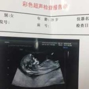 鼻骨未显示怎么回事,胎儿鼻骨未见显示什么意思