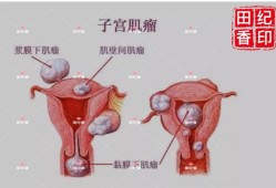 怀孕了，但查出有子宫肌瘤要紧吗,怀孕期间子宫肌瘤怎么办?