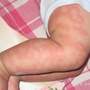 5个月胎儿图片（5个月宝宝身上起疙瘩怎么办）