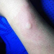 孕期青霉素（大家知道孕妇为什么会对青霉素过敏呢）