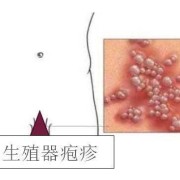 孕期单纯疱疹病毒（I型单纯疱疹病毒感染，对怀孕有影响吗）