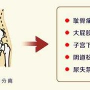 孕妇盆骨痛是什么原因,孕期骨盆疼痛如何缓解