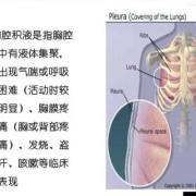胎儿胸腔积液（胎儿胸腔积液是什么原因造成的）