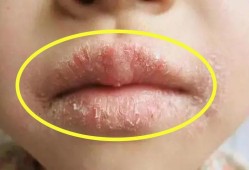 孕妇嘴唇干裂怎么办,孕期嘴唇干裂起皮什么原因造成的
