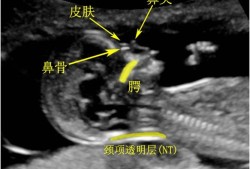胎儿鼻骨各孕期标准,胎儿鼻骨可见什么意思