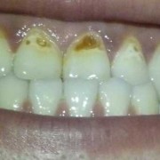 孕期牙齿缺（全瓷牙缺了还能补吗，靠近牙龈处掉了一小块）