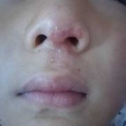 胎儿鼻梁矮（宝宝口腔发热，鼻子出热气，怎么回事）