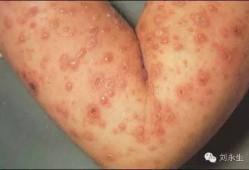 孕妇得水痘胎儿能要吗（孕妇得水痘对胎儿影响）