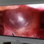怀孕期有囊肿怎么办（怀孕期有囊肿怎么办啊）