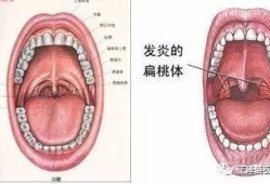 孕妇嗓子发炎肿痛怎么办,孕期喉咙肿痛怎么办咽口水都痛怎么办