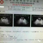 产检b超看什么,孕期b族链球菌是查什么的