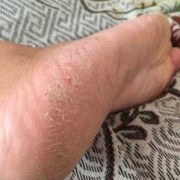 孕期脚凉（孕期脚凉对胎儿有影响吗）