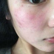 孕期脸上过敏怎么办,孕期脸上过敏红肿痒怎样快速消除