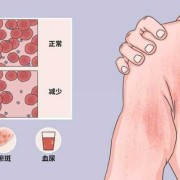 孕妇血小板低有什么影响,怀孕了血小板低会影响胎儿吗