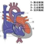 胎儿肺动脉狭窄（胎儿肺动脉狭窄能不能要）