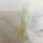 孕期白带发黄粘稠图片（怀孕了白带发黄是怎么回事）