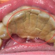 孕期牙结石（孕期牙结石）