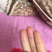 孕期手上脱皮（孕期手上脱皮是怎么回事）