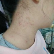 孕期不长痘痘（以前不长痘痘，为什么怀孕后长痘痘呢）