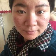 怀孕期间脸上长痘痘该怎么办,怀孕期间粉刺多怎么处理