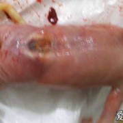 胎儿脑积水孕妇症状（胎儿脑积水孕妇症状）