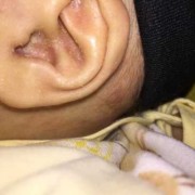 耳朵里面湿疹流水怎么办,孕期湿疹流水怎么办啊