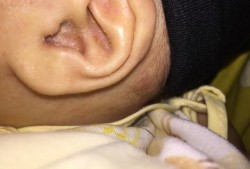 耳朵里面湿疹流水怎么办,孕期湿疹流水怎么办啊