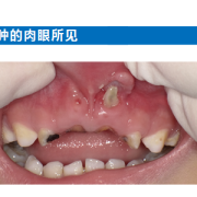 胎儿上牙槽骨（儿童牙齿长在牙龈上）
