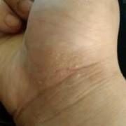 孕期手上起了湿疹怎么办（手上长湿疹怎么办）