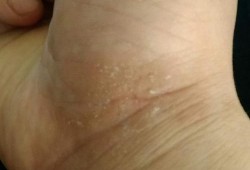 孕期手上起了湿疹怎么办（手上长湿疹怎么办）