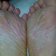 怀孕期间脚气严重怎么办（孕妇有脚气怎么办，特痒,孕妇有脚气怎么）