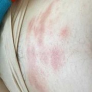 孕早期肚皮痒怎么回事,孕期腹部瘙痒怎么回事