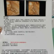 产检nf是什么,孕期nf检查是什么检查
