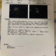 看b超单怎么算胎儿体重（37周双顶径95股骨长71能算出胎儿多重吗）