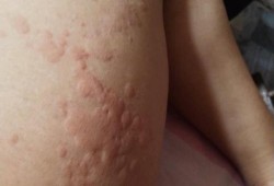 孕期荨麻疹发作怎么办（孕早期荨麻疹怎么办）