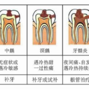 孕期蛀牙怎么办（孕期蛀牙怎么办才能治好）