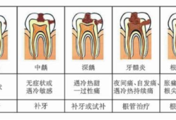 孕期蛀牙怎么办（孕期蛀牙怎么办才能治好）