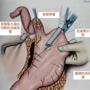 孕晚期胎儿往上顶（食道癌胃癌做完手术吃东西往上顶气怎么回事）