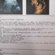 产检nf是什么,孕期nf检查是什么检查