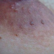 孕妇乳晕上有白色颗粒是什么原因,孕期乳晕上长小疙瘩怎么回事