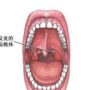 孕妇嗓子发炎肿痛怎么办,孕期嗓子肿痛发炎怎么办