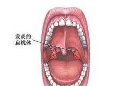 孕妇嗓子发炎肿痛怎么办,孕期嗓子肿痛发炎怎么办