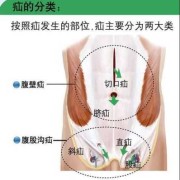 孕期腹股沟疝（儿童腹股沟疝气）
