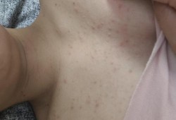 怀孕中期，为什么屁股上长小豆豆,孕期胸长痘痘怎么回事