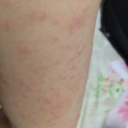 怀孕11周，胳膊、腿上身上长了好多湿疹，痒的受不了，有什么,孕期脸上长湿疹怎么办啊