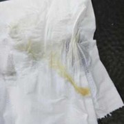 孕妇白带发黄正常吗,孕期小便发黄正常吗