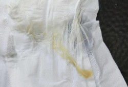 孕妇白带发黄正常吗,孕期小便发黄正常吗