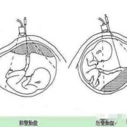 胎盘前壁和后壁胎儿图（胎盘前壁和后壁胎儿图片对比）