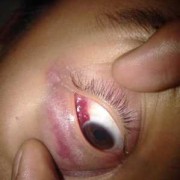 眼皮肿眼睛睁不开怎么办,胎儿眼睛什么时候睁开的